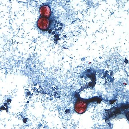 What to know about cyclosporiasis as the parasitic infection is found in 34 states